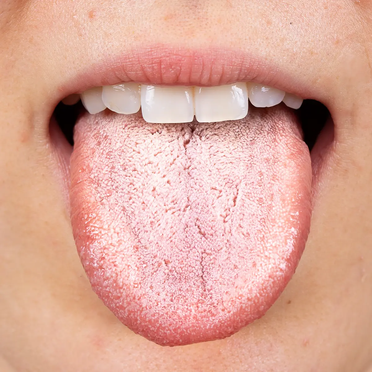 Sopp i munnen tannlege trondheim lade tannhelsesenter